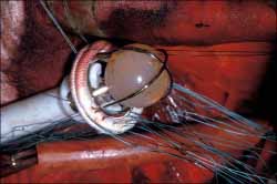 heart valve